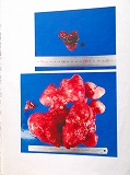 30cm大の子宮摘出物と卵巣です。卵巣は黒い出血がある為、チョコレート嚢腫との事です。