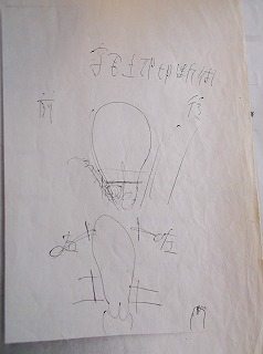 「卵巣はおいておく」という説明のイラスト、子宮の両側に、卵巣との間に線が入っています。